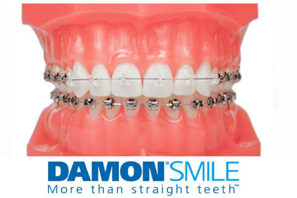 Damon Braces