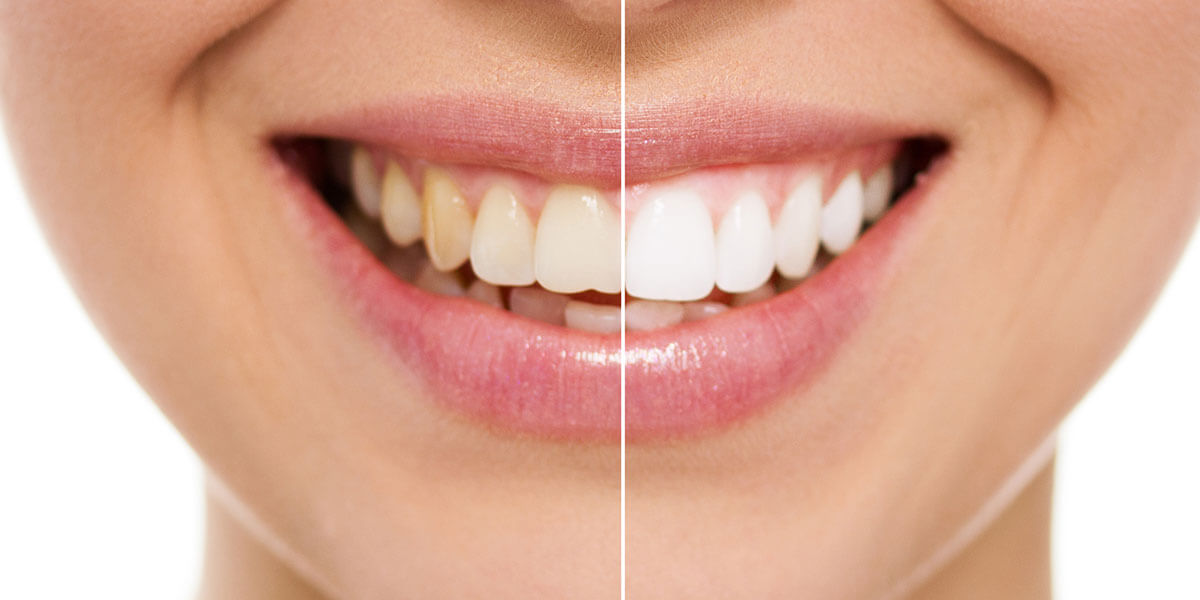 Before and After Whitening